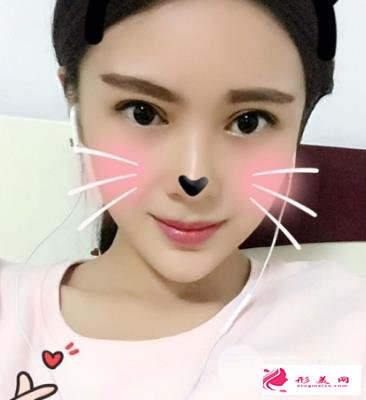 成都刘辅容双眼皮修复到底怎么样?和大家分享一波刘辅容眼修复案例