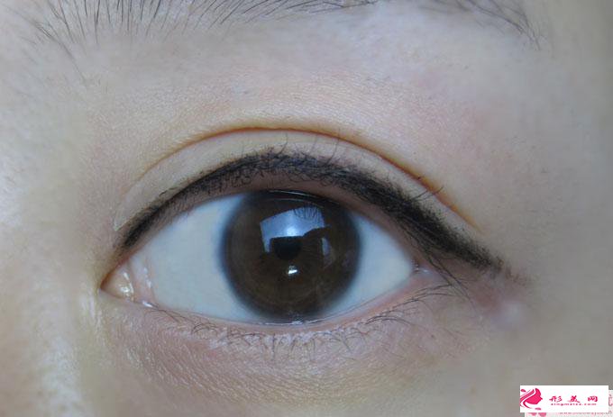 变成双眼皮差不多怎么算价格呢?