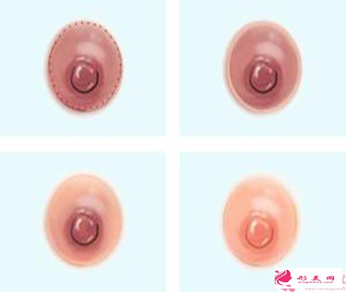 乳晕缩小手术后遗症_乳晕缩小手术后会留疤吗?