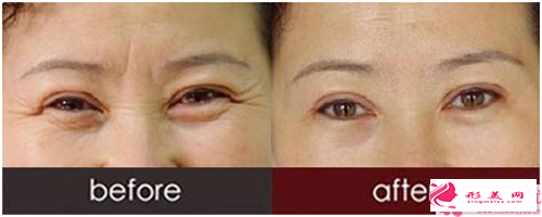 哪些人适合除皱手术_除皱手术每个人都适合吗?