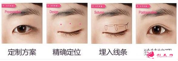 韩式三点双眼皮手术示意图
