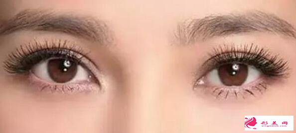 埋线双眼皮可以做第二次吗