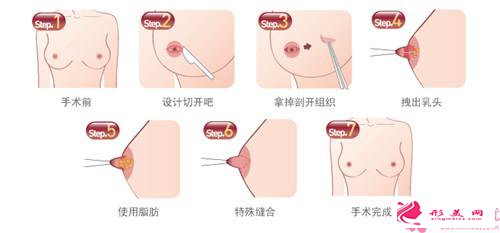  乳头内陷的花费_乳头内陷矫正手术需要多少钱