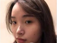 重庆军科整形医院好不好?范文亮隆鼻案例