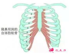 什么情况下不能做肋软骨隆鼻吗？