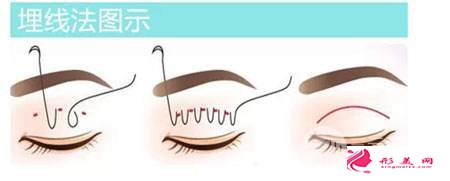 成都华西医院做埋线双眼皮