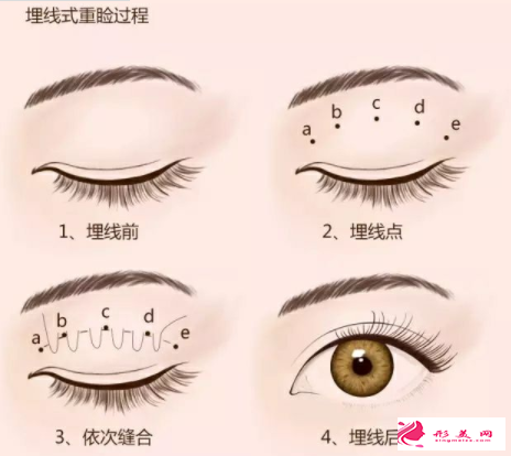 眼皮松弛也能做埋线双眼皮吗