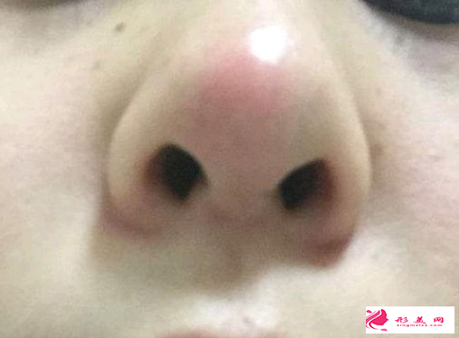 隆鼻失败修复什么时间段比较好