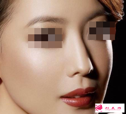 隆鼻失败修复什么时间段比较好