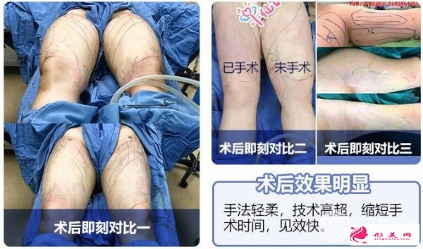 大腿吸脂术效果图
