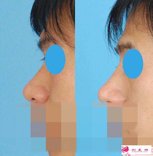 自体脂肪垫鼻部的效果怎么样