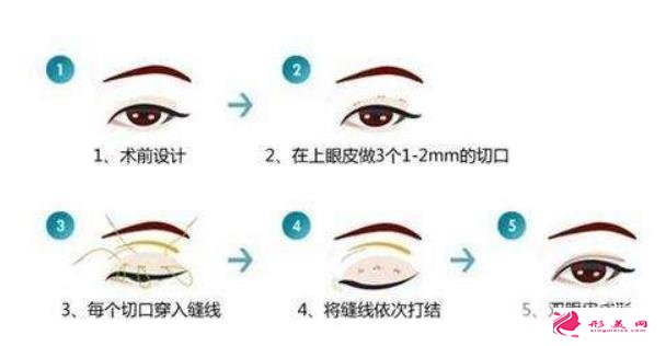 做双眼皮需要多少钱啊？手术方式不同价格不一样~