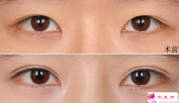 割双眼皮是全麻还是局麻