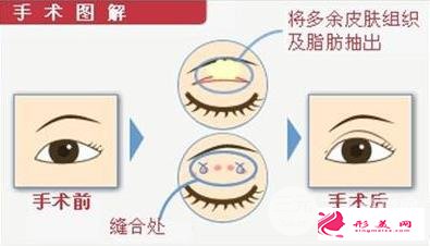 肿眼泡的福星：眼皮抽脂术效果好不好~