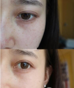 成都八大处做祛斑怎么样？好不好？附激光祛斑案例