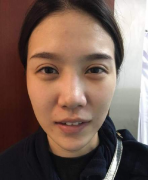 北京八大处李发成脂肪填充全脸怎么样？ 仙女效果图曝光！