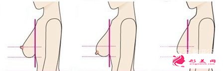 胸部下垂整形要多少钱？胸部下垂整形手术方式有很多~