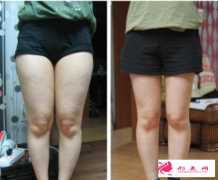吸脂真的能够瘦大腿吗？