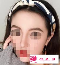 医生做的肋软骨隆鼻效果如何,进来瞧瞧吧