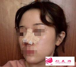 医生做的肋软骨隆鼻效果如何,进来瞧瞧吧