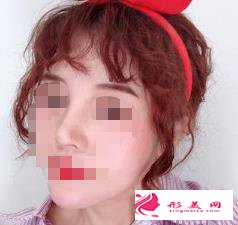 医生做的肋软骨隆鼻效果如何,进来瞧瞧吧