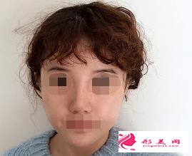 医生做的肋软骨隆鼻效果如何,进来瞧瞧吧