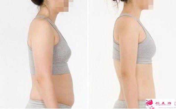 影响手臂吸脂手术价格的因素有哪些？