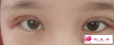 眼综合拯救了我的正泡眼,选择医生是关键