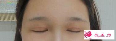 眼综合拯救了我的正泡眼,选择医生是关键