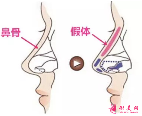 做假体隆鼻后可以洗脸吗