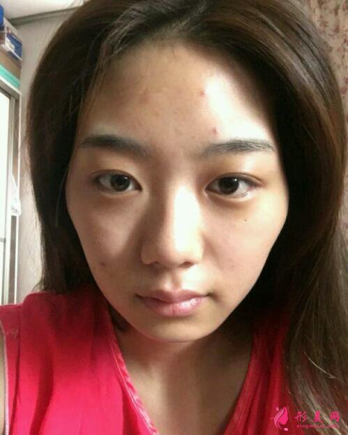 深圳非凡整形医院面部填充好吗?真人案例图反馈