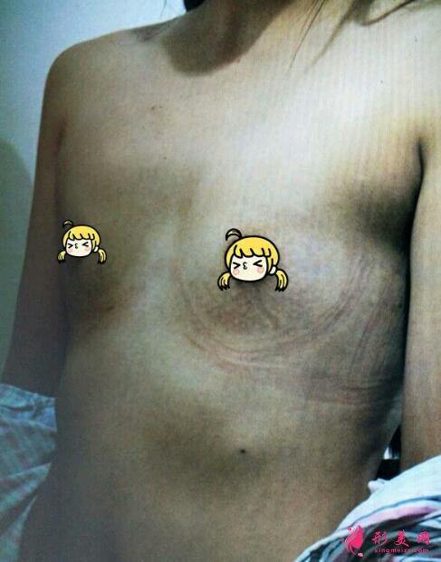 硅胶隆胸效果怎样?这位小姐姐做的案例图从A罩杯晋升C!