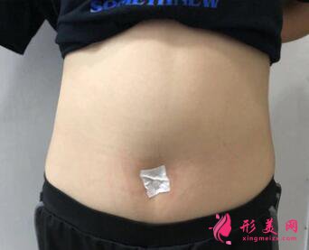 360吸脂案例对比,成功瘦身成为大美女啦!