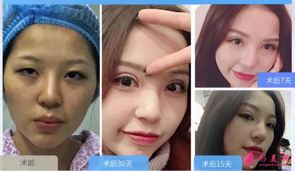 深圳做开内眼角多少钱?