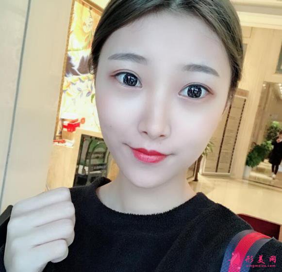 深圳回来医疗整形医院脂肪填充案例,院长技术很不错~