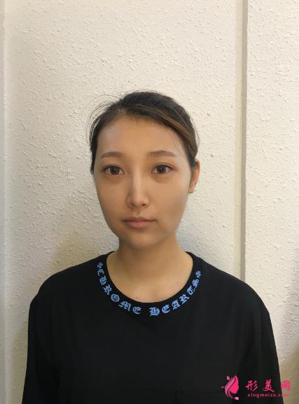 深圳回来医疗整形医院脂肪填充案例,院长技术很不错~