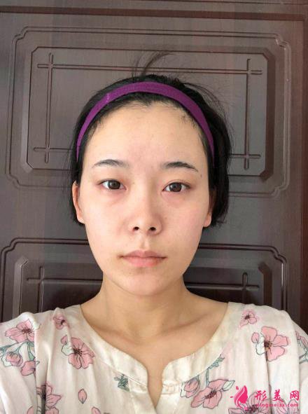 深圳美莱双眼皮隆鼻案例图鉴赏,糟糕,是心动的感觉~