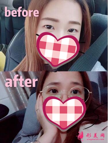 深圳米兰柏羽做眼睛怎么样?这个案例图告诉你答案