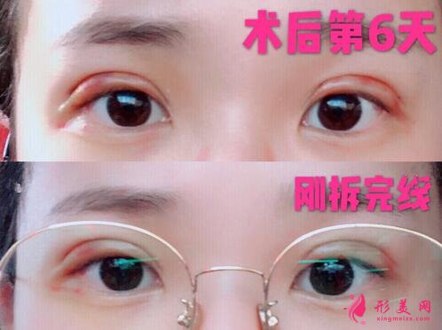 深圳米兰柏羽做眼睛怎么样?这个案例图告诉你答案