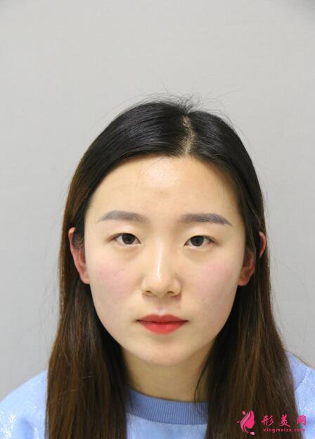 开眼角和双眼皮一起做的效果图,是你喜欢的style吗?