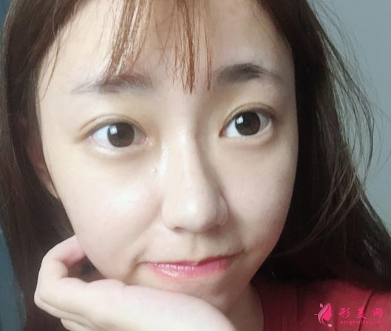 双眼皮案例:双眼皮手术时