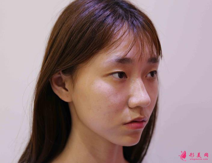 深圳铭医张青松案例:双眼皮案例之小姐姐的美丽蜕变