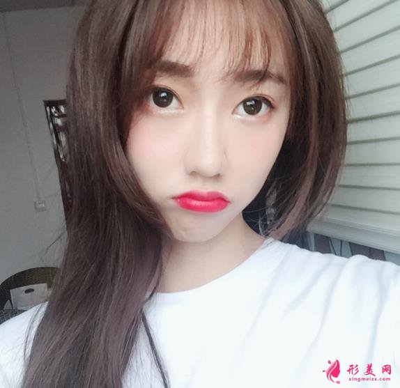 双眼皮案例:双眼皮手术时