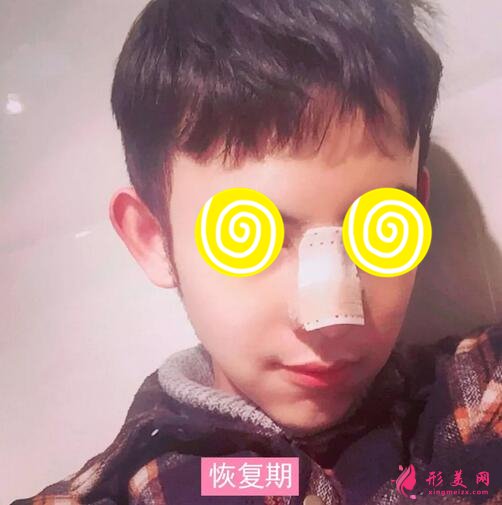 【案例】深圳人民医院隆鼻案例,三甲技术确实不错!