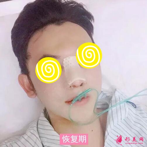 【案例】深圳人民医院隆鼻案例,三甲技术确实不错!