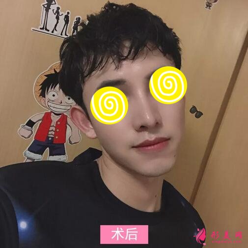 【案例】深圳人民医院隆鼻案例,三甲技术确实不错!