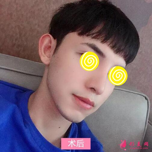 【案例】深圳人民医院隆鼻案例,三甲技术确实不错!