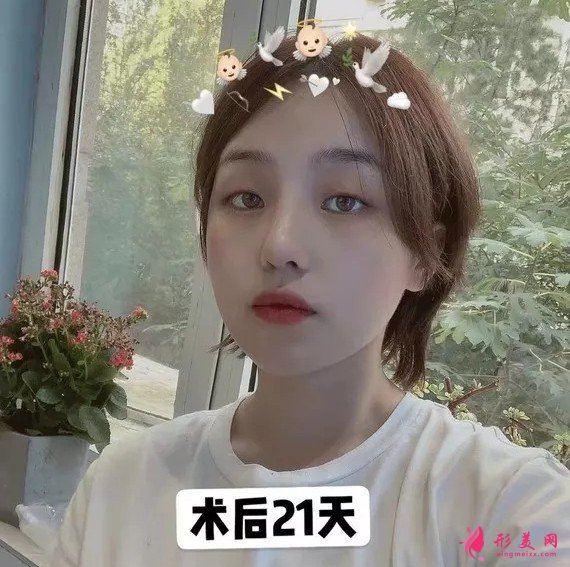 李信锋做鼻子怎么样?看看案例图就知道医生技术了