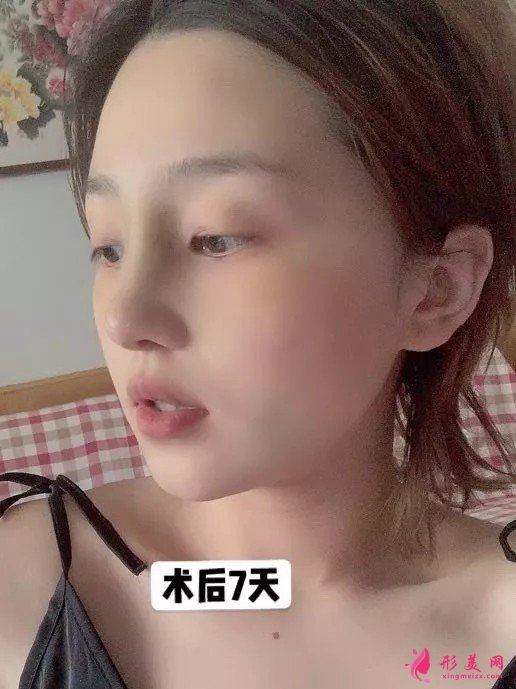李信锋做鼻子怎么样?看看案例图就知道医生技术了