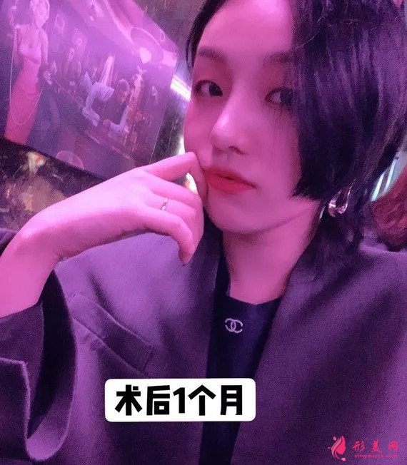 李信锋做鼻子怎么样?看看案例图就知道医生技术了